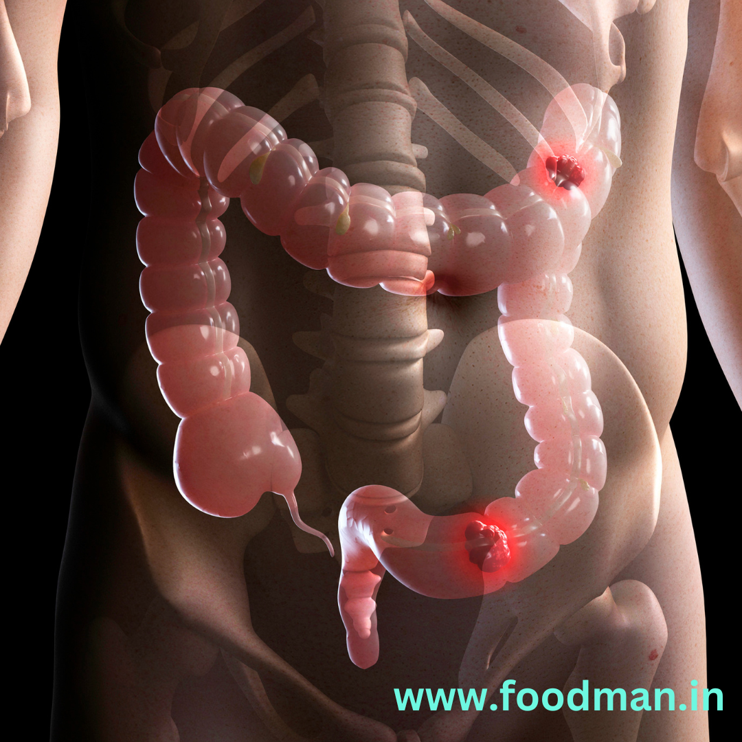 intestines' cancer